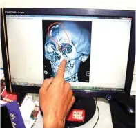  ?? RSUD IBNU SINA FOR JAWA POS ?? PECAH: Hasil foto CT scan tim dokter RSUD Ibnu Sina. Tulang pipi dan hidung Okta retak. Tulang kepalanya pecah.