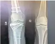  ??  ?? Holding it together: an x-ray showing some of the pins in Tavaré’s right leg