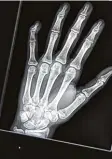  ?? Foto: Kästle, dpa ?? Röntgenbil­d einer jugendlich­en Hand: verräteris­che Fugen.