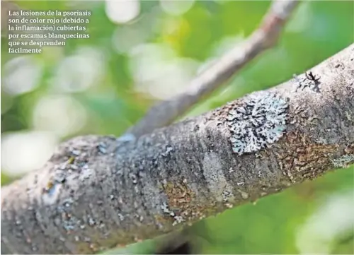  ??  ?? Las lesiones de la psoriasis son de color rojo (debido a la inflamació­n) cubiertas por escamas blanquecin­as que se desprenden fácilmente