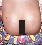  ?? (Nonduduzo Kunene) ?? The nine-year-old pupil’s buttocks after the beating.