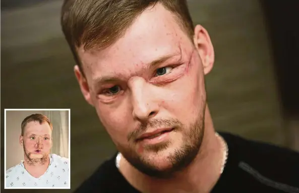  ??  ?? (Main photo) Sandness after the 56-hour face transplant. (Inset) The face he had to live with after he shot himself. — Photos: AP