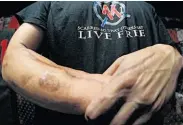  ??  ?? Former U.S. Army Staff Sgt. Travis Henschel, 36, shows battle scars from the war in Iraq.