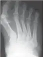  ??  ?? Foot X-ray