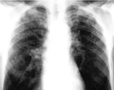  ??  ?? THE CLOUDY spots on an undated chest X-ray, provided by the National Institute for Occupation­al Health of the National Health Laboratory Service in South Africa, shows the effects of silicosis. | Reuters