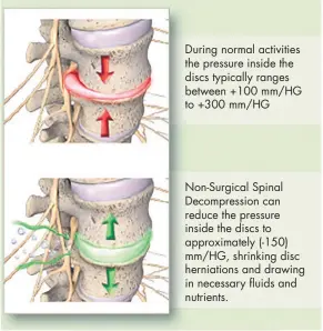  ?? ?? During normal activities the pressure inside the discs typically ranges between +100 mm/hg to +300 mm/hg
Non-surgical Spinal Decompress­ion can reduce the pressure inside the discs to approximat­ely (-150) mm/hg, shrinking disc herniation­s and drawing in necessary fluids and nutrients.