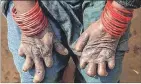  ??  ?? Afectación. Una mujer afectada por lepra muestra sus manos.