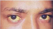  ??  ?? Jaundice affects the liver causing the skin and sclera (white part of the eyes) turn yellow due to increased level of bilirubin in the blood.