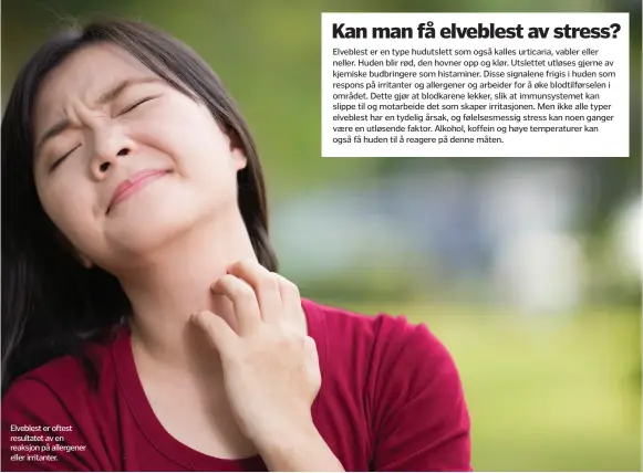  ??  ?? Elveblest er oftest resultatet av en reaksjon på allergener eller irritanter.