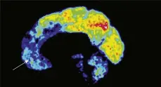  ??  ?? ABOVE RIGHT: In the scan of the normal brain, there is activity in the frontal lobe (marked with an arrow), which is associated with emotional response; in the psychopath brain, there is little activity in this region PSYCHOPATH