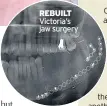  ??  ?? REBUILT Victoria’s jaw surgery