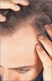  ?? Contribute­d ?? Millions of men and women experience hair loss in some shape or form in their lives.
