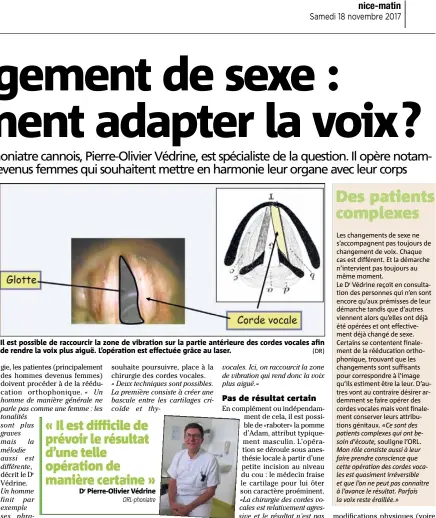  ??  ?? Il est possible de raccourcir la zone de vibration sur la partie antérieure des cordes vocales afin de rendre la voix plus aiguë. L’opération est effectuée grâce au laser. (DR)