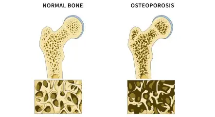  ??  ?? The difference in a normal bone and one affected by osteoporos­is.