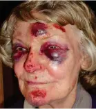  ??  ?? Horrific injuries: This woman in her 80s did not get compensati­on