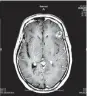  ??  ?? PICTURE OF THE PROBLEM: A scan of the patient’s brain