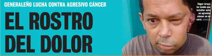  ?? CORTESÍA ?? Édgar Araya ha tenido que batallar ante
un agresivo cáncer en su cara.