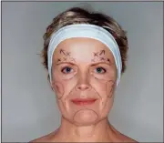  ?? CONTRIBUTE­D PHOTO ?? Dalton Plastic Surgery performs light cosmetic procedures such as botox injections and eye tucks, to more permanent procedures such as face lifts.