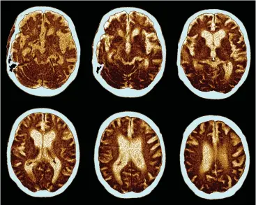  ?? ?? Alarming: Scans show signs of dementia. One of the main features is the brain shrinks