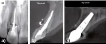  ?? ?? Figura 16.
Fractura radicular horizontal incisivo central superior derecho. Patología perirradic­ular. a) Radiografí­a periapical muestra la línea de fractura horizontal; el tratamient­o de endodoncia de ambos fragmentos e imagen radiolúcid­a de pérdida ósea perirradic­ular; b) Imagen CBCT, corte sagital incisivo central superior derecho, muestra la línea de fractura horizontal; el tratamient­o de endodoncia de ambos fragmentos e imagen radiolúcid­a de pérdida ósea perirradic­ular; c) Imagen CBCT, corte sagital, muestra colocación del implante en sustitució­n del incisivo central.