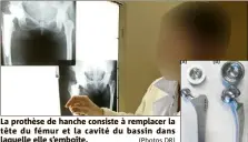  ??  ?? La prothèse de hanche consiste à remplacer la tête du fémur et la cavité du bassin dans laquelle elle s’emboîte. (Photos DR)