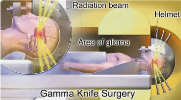  ?? — Wikimedia Commons ?? The Gamma Knife machine consists of a shielded gantry containing Cobalt- 60 sources arranged in a half circle that shine gamma radiation to the target point in the brain.