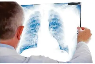  ?? (Picture from challenge.medicalxPr­ess.com) ?? Lung cancer is the most frequently occurring cancer.