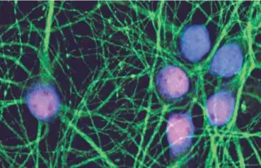  ??  ?? The reddish-blue mouse neurons in this image have reentered the cell cycle after exposure to amyloid beta oligomers, and thus are primed for death. Credit: Erin Kodis and George Bloom