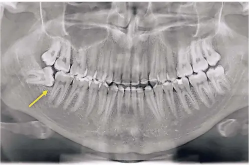 ?? FOTO: DPA ?? Drei Weisheitsz­ähne sind ordnungsge­mäß durchgebro­chen, einer jedoch liegt quer im Kiefer. Er muss entfernt werden – und sein Gegenüber auch.