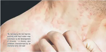  ??  ?? ‘By damaging the skin barrier, washing with hard water may contribute to the developmen­t of eczema - a chronic skin condition characteri­sed by an intensely itchy red rash.’