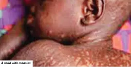  ?? ?? A child with measles