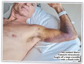  ?? ?? FNQ resident Marco Tiraboschi miraculous­ly fought off a large crocodile with a sheath knife.