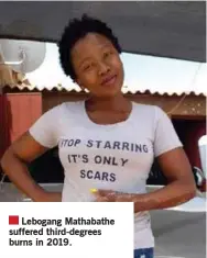  ??  ?? Lebogang Mathabathe suffered third-degrees burns in 2019.