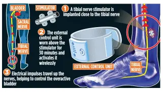  ??  ?? STIMULATIO­N: How the device ‘communicat­es’ with the bladder