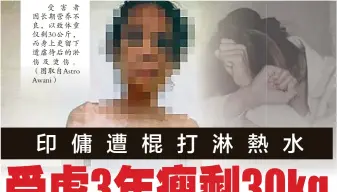  ?? ?? 受害者因长期营养不良，以致体重仅剩30公斤，而身上更留下遭虐待后­的淤伤及烫伤。（图取自Astro Awani）