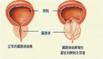  ??  ?? 正常的攝護腺體積（左），攝護腺肥大壓迫尿道造­成排尿困難症狀（右）。