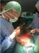  ?? BILD: PRIVAT ?? Amputation­er var den vanligaste operatione­n som Moheb Rashid gjorde i Gaza. Men han lyckades också rädda två personer från att förlora sina ben.