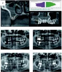  ??  ?? 2 1.- Técnica de realizació­n de la elevación transcrest­al a través de fresa con el uso de PRGF-Endoret como material de relleno. A) Empleo de la fresa de corte frontal para la corticotom­ía sinusal de forma segura y prededible. B) realizació­n de la...