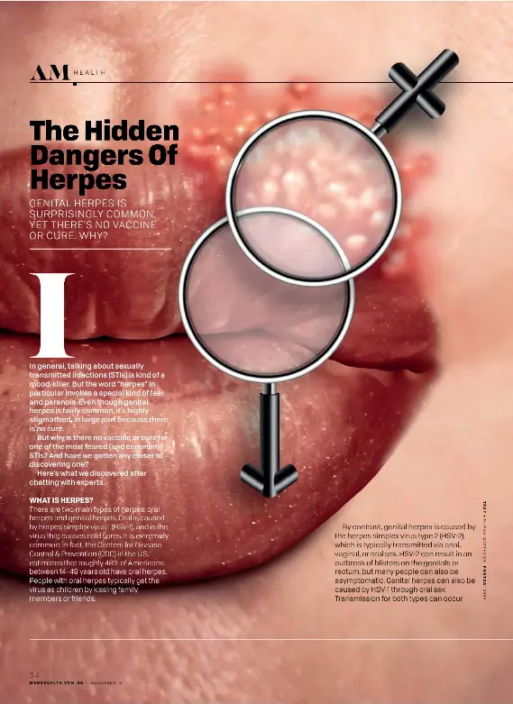 herpes type 1 genital pictures
