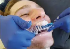  ?? Stan Hudy shudy@ digitalfir­stmedia. com @StanHudy on Twitter ?? Shenendeho­wa junior defenseman Christophe­r Lasher has a mold filled with compound placed against his top teeth to create a mold for this year’s hockey mouth guard courtesy of Clifton Park Othodontic­s.