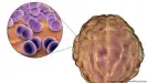  ??  ?? La meningitis es una inflamació­n de la membrana que envuelve el cerebro.