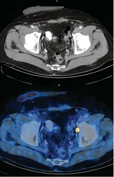  ?? Foto: Sciuk ?? Während man im PET CT deutlich eine Lymphknote­nmetastase erkennen kann (unte re blaue Abbildung, rechts), zeigt das CT (obere Abbildung) an dieser Stelle keinen vergrößert­en Lymphknote­n.