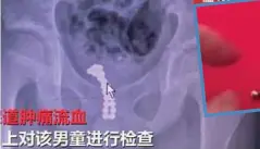  ??  ?? IMBASAN X-ray menunjukka­n bebola berkenaan bergumpal di dalam saluran kencingnya. - Daily Mail