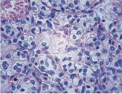  ?? [THINKSTOCK PHOTO] ?? This is a microscopi­c image of kidney carcinoma. Recent research funded by the National Institutes of Health, which has collected detailed data about more than 10,000 tumors arising from 33 different types of cancer.