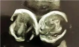  ?? ?? Brotherly love...scan shows how the boys’ umbilical cords were tangled in a ‘friendship’ knot; left, the twins soon after their birth in 2020