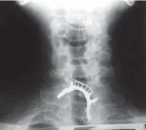  ?? Arquivo Pessoal ?? Imagem do raio-X mostra a dentadura presa na garganta de Antonio Monteiro Cantalice, 59 anos