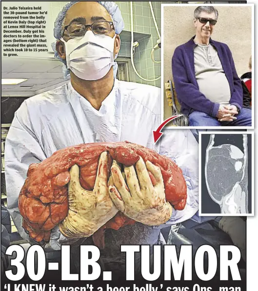  ??  ?? Reuven Blau and James Fanelli Dr. Julio Teixeira held the 30-pound tumor he’d removed from the belly of Kevin Daly (top right) at Lenox Hill Hospital in December. Daly got his doctors to order the images (bottom right) that revealed the giant mass,...