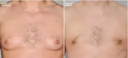  ?? ?? Left, a 21-year-old patient with severe gynaecomas­tia. Right, a mid-30s patient with mild gynecomast­ia, both before and six weeks after treatment. Images courtesy of Mr Mo Akhavani.