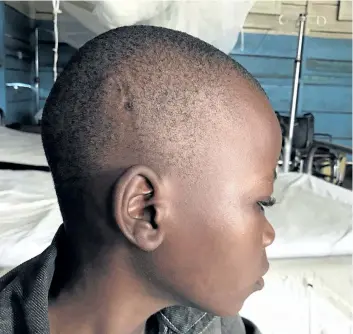  ?? PATRICK ROSE/UNICEF VIA AP ?? In this Aug. 29 photo made available by UNICEF, a boy displays a scar from a tracer bullet in Mbuji Mayi, Kasai province, Democratic Republic of the Congo. Congo’s Kasai region is the latest deadly hotspot in the vast Central African country that has...