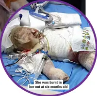  ?? ?? She was burnt in her cot at six months old